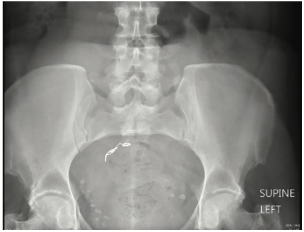 Coil Embolization to the Right Side of the Heart After Elective